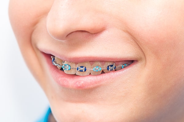 Tooth coloured braces