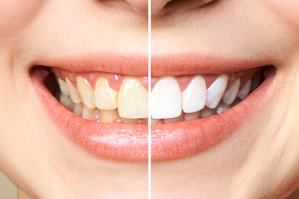 Denplan Tooth Whitening